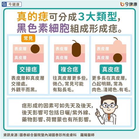 長痣原因|是痣or皮膚癌？醫「1張圖秒對照」 長這2部位最危險